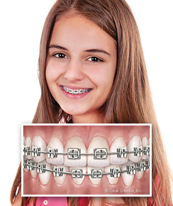 Traditional Metal Braces.