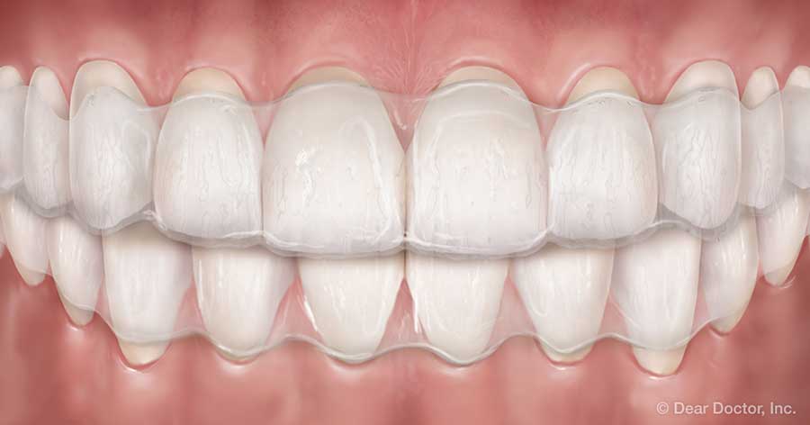 Clear aligners.