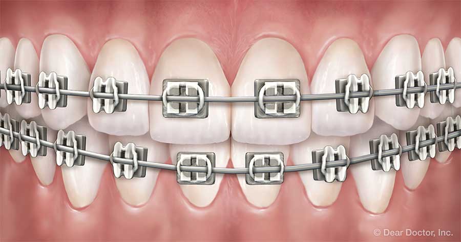 Diagram of metal braces.