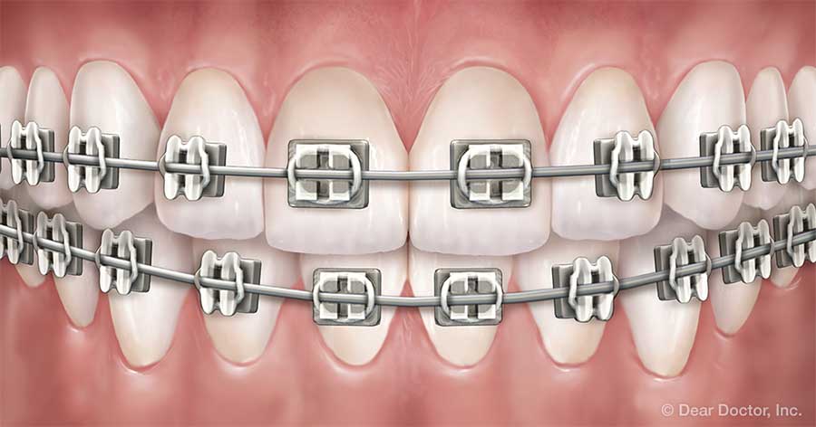 Metal braces