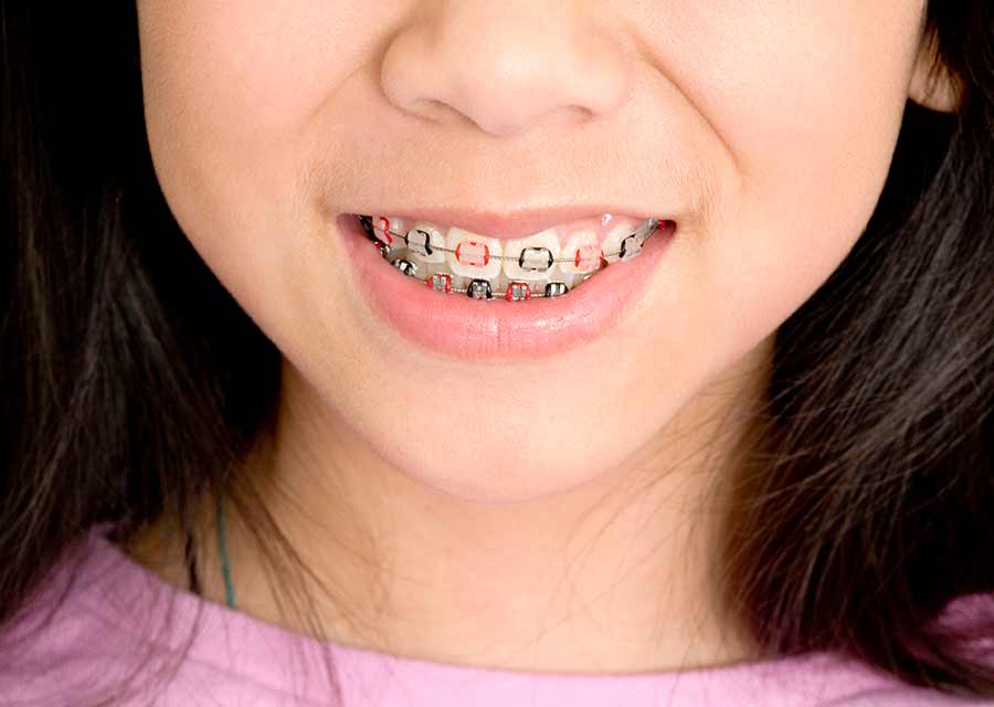 Young adolescent girl wearing braces