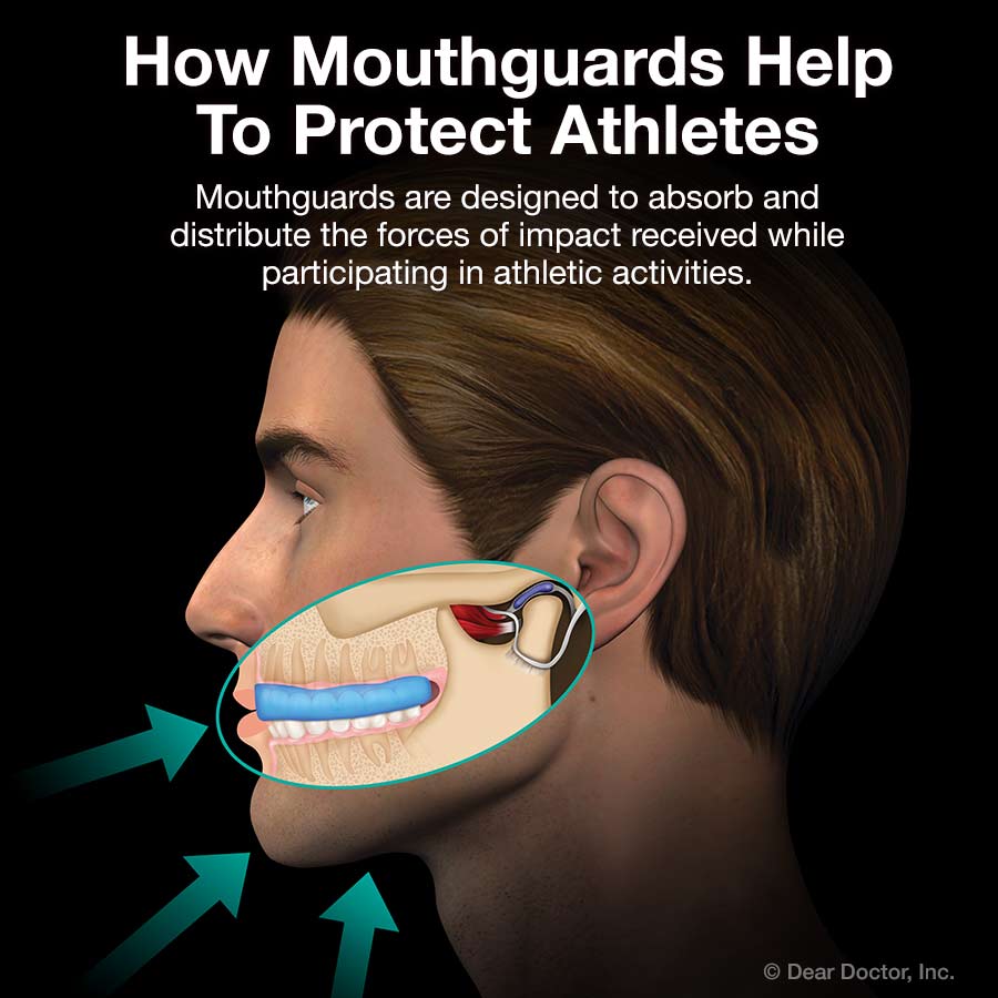 Athletic mouthguards.