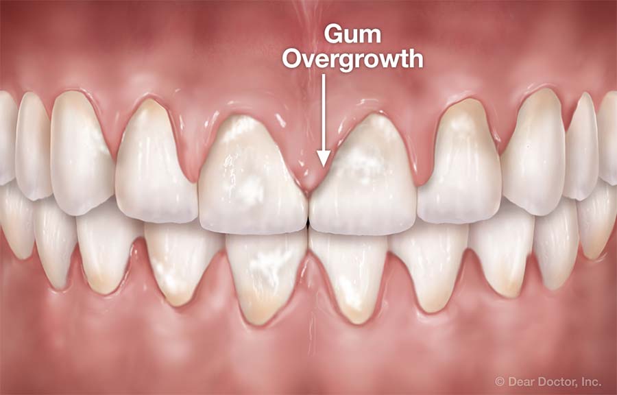 Gum Overgrowth.