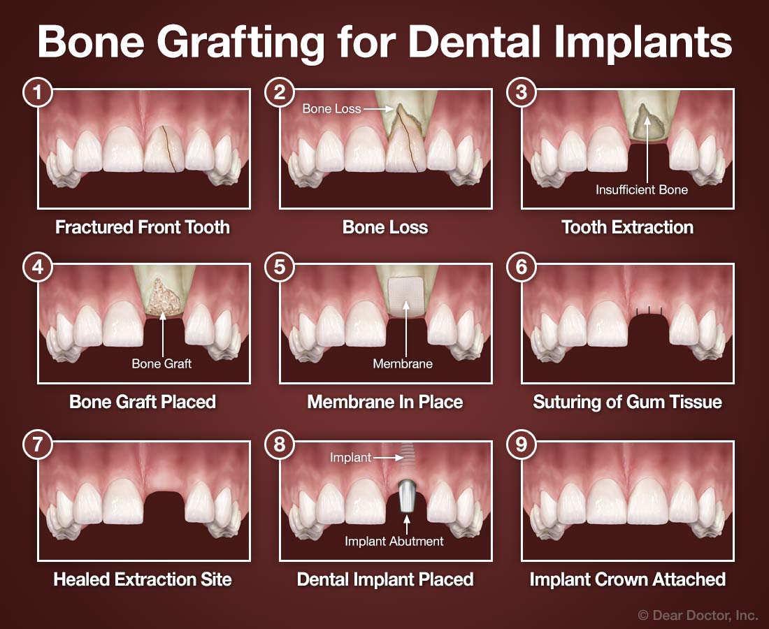 Bone grafting for dental implants.