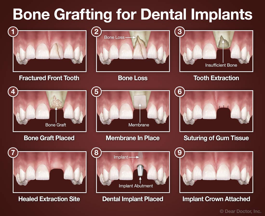 Bone Grafting for Dental Implants | Stanley R. Beard, D.M.D., FAGD
