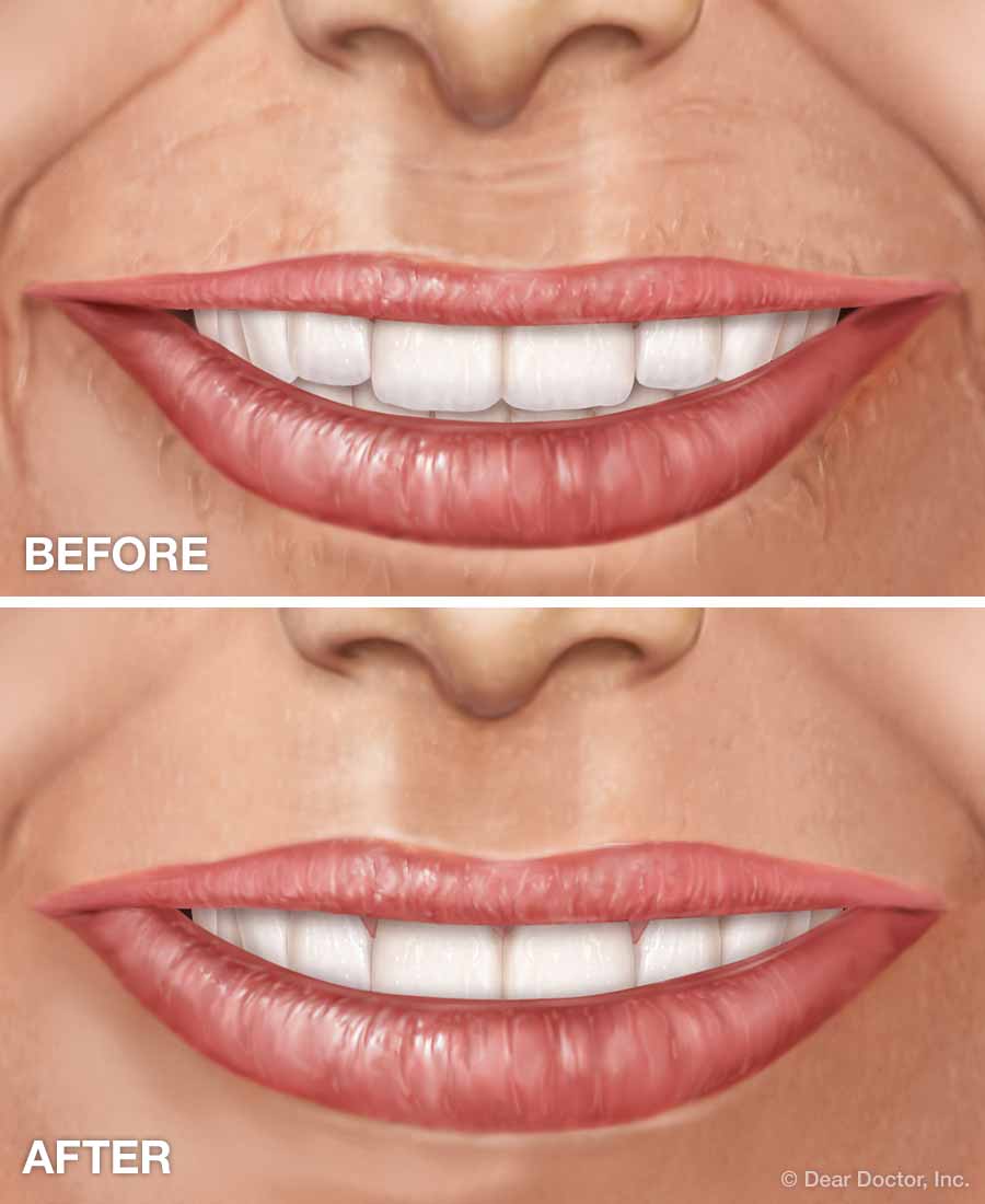 Cosmetic fillers before and after.