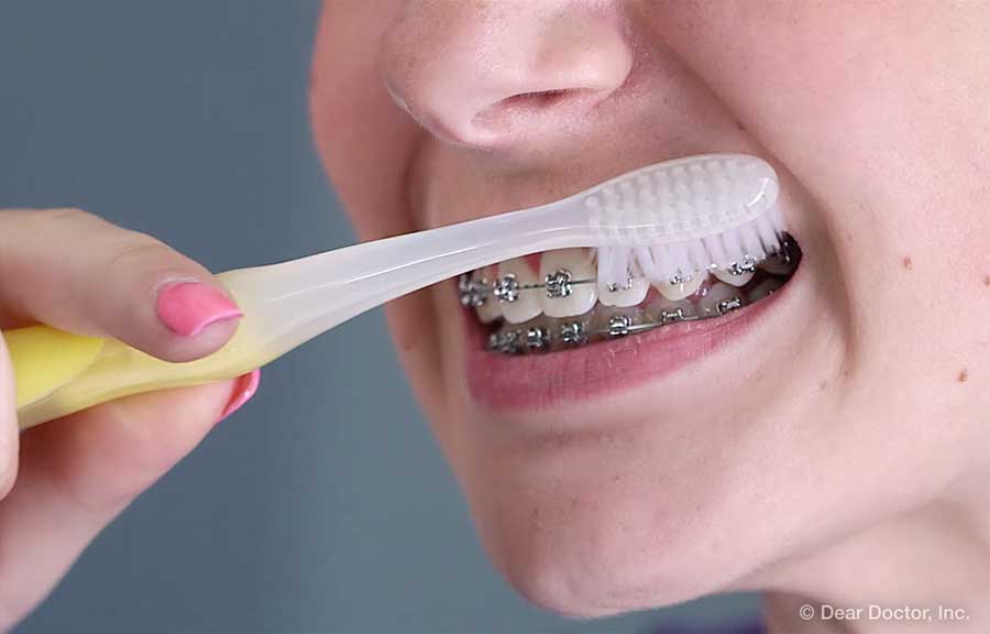 Person brushing with braces
