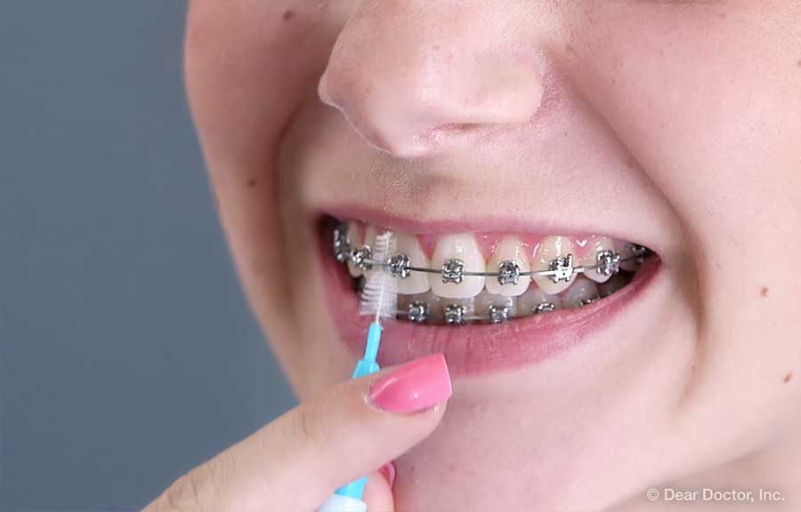 Person using an interdental toothbrush.