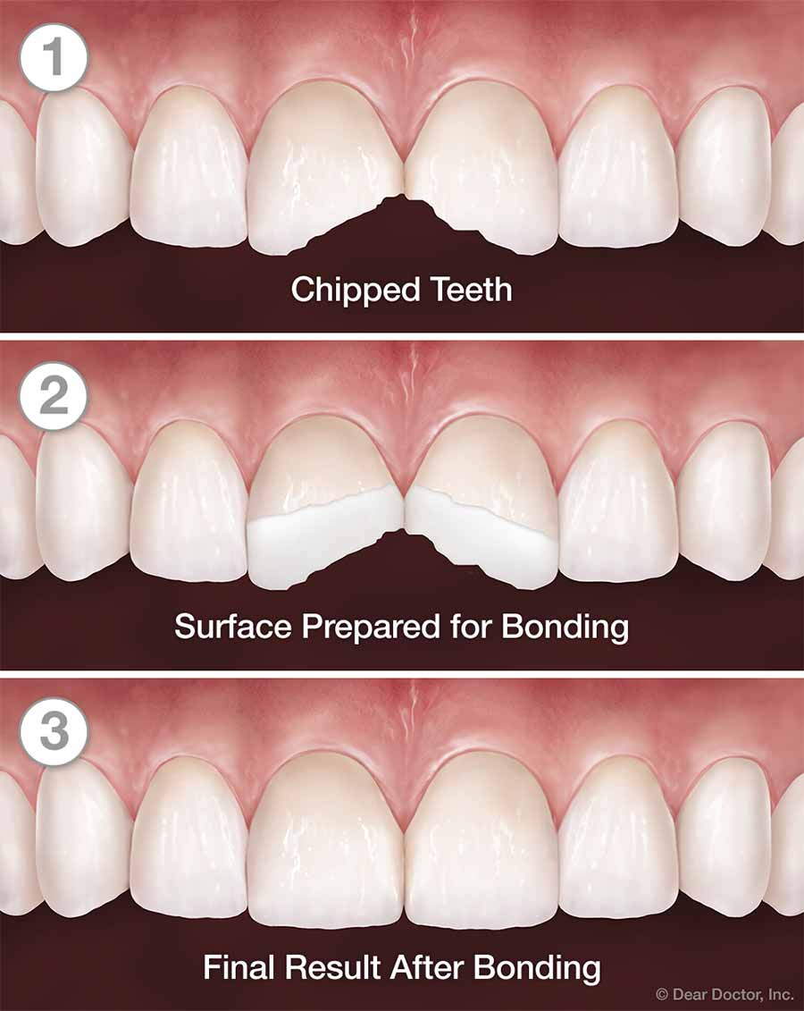 Chipped Tooth Repair. Do I Really Need It? - Guzaitis Dental Group