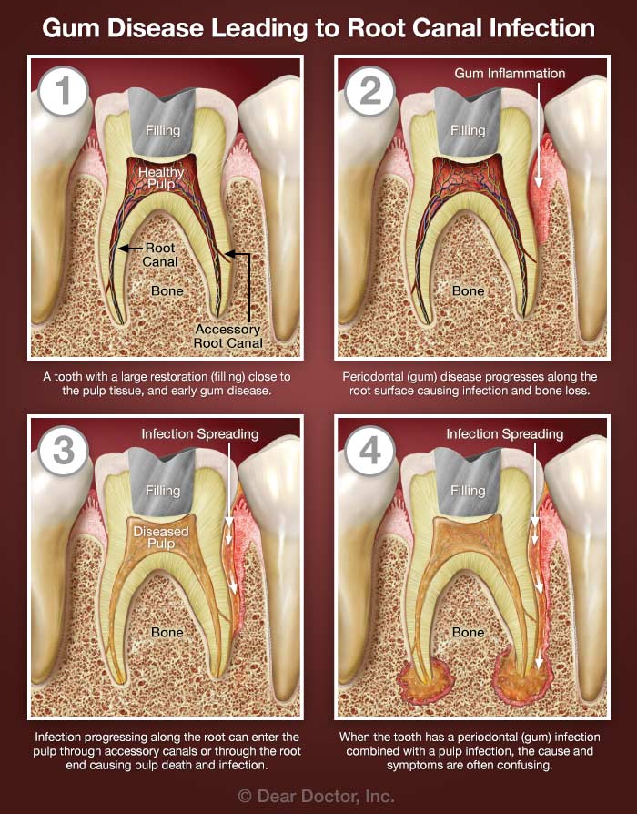 Gum disease leading to root canal infection.