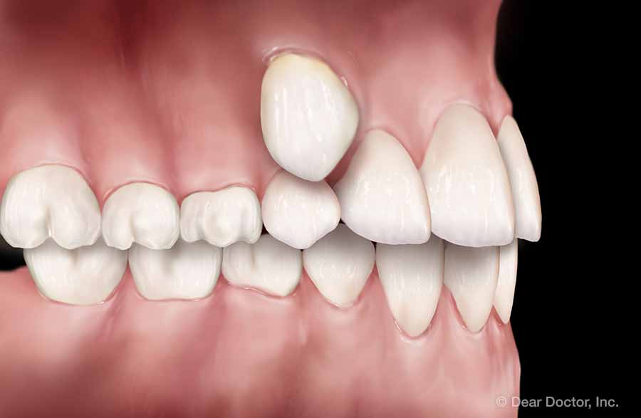 Overbite: Causes, Risks and Treatment — WoodSprings Dentistry