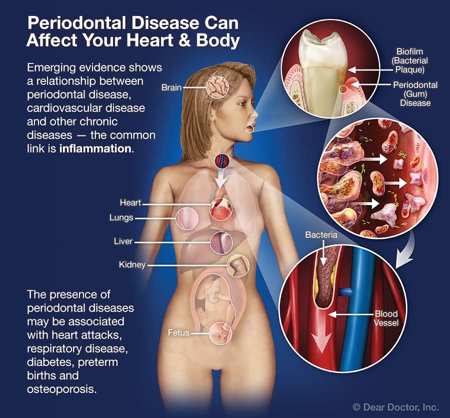 Gum disease can affect your heart and body.