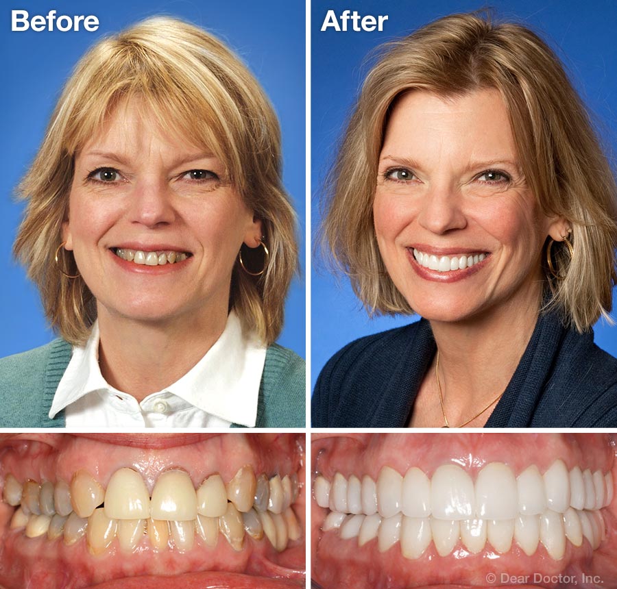 Dental Implants Near Me