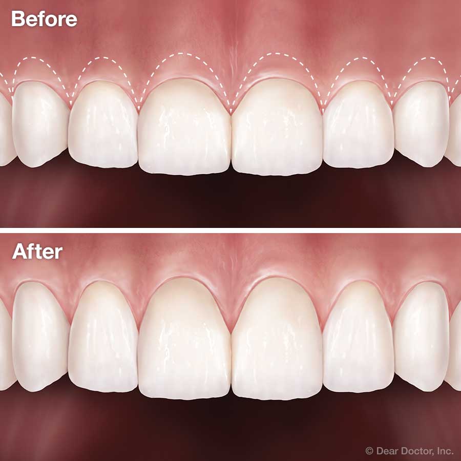 Cosmetic gum surgery.