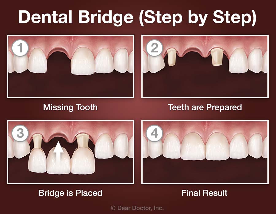 Dental Bridge - Step by Step.