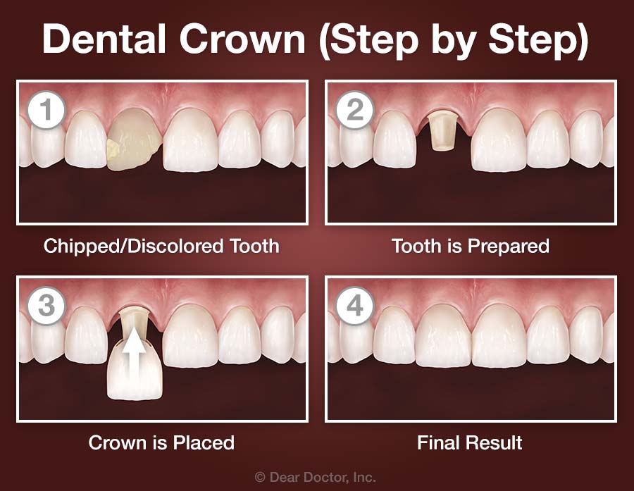 Crowns & Bridgework Dr. Shelley Lyle, Dr. Mary Davis, and Dr. Ella