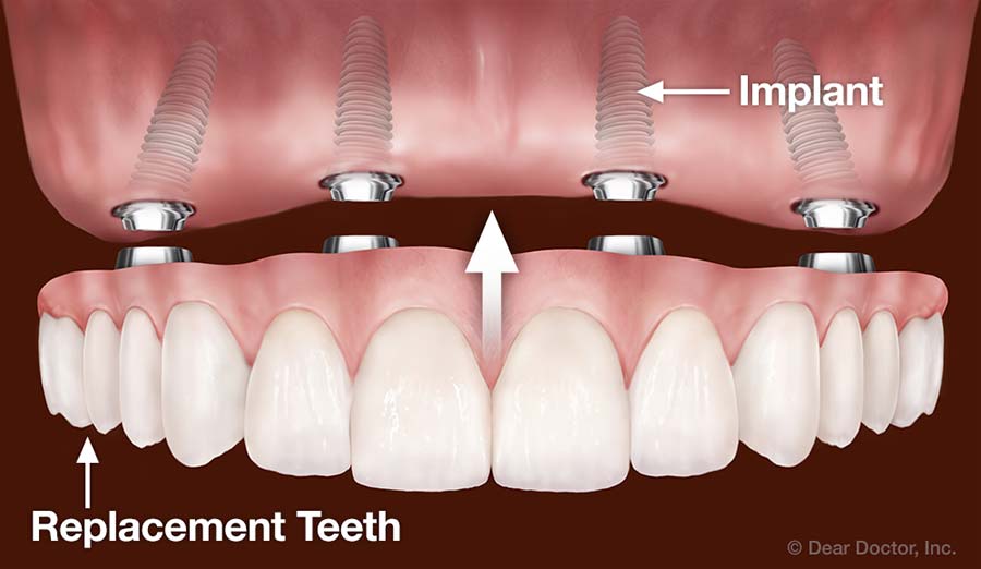 Illustration of how dental implants work for replacing all teeth