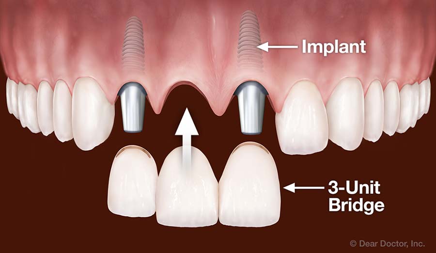 Illustration of how dental implants work for multiple teeth replacement