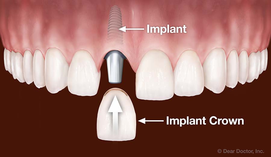 Illustration of how a single dental implant works for tooth replacement