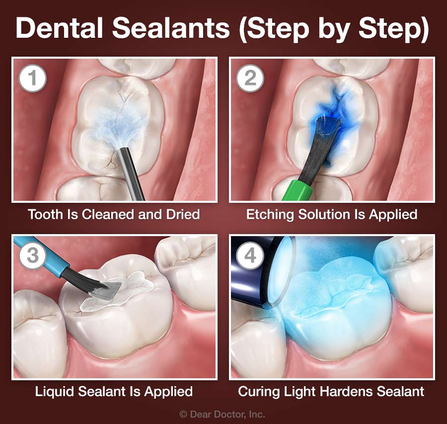 Dental Sealants The Children S Choice