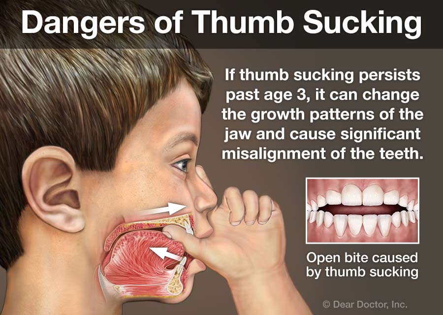 Dangers of Thumb Sucking Chart. Orthodontic issues caused by thumb sucking that may require braces