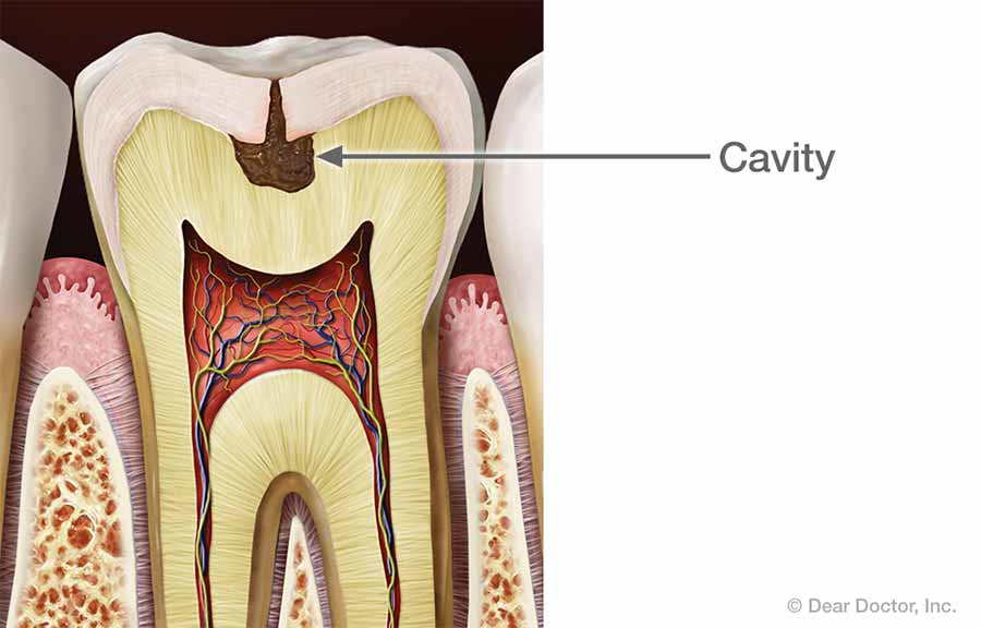 Fillings | Dr. Curtis Kaiser | College Station TX