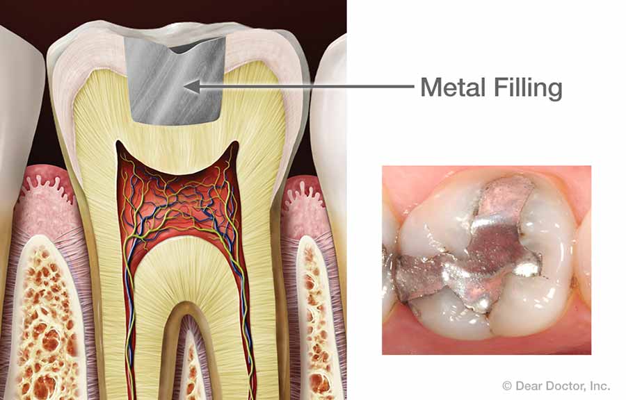 Metal Filling.