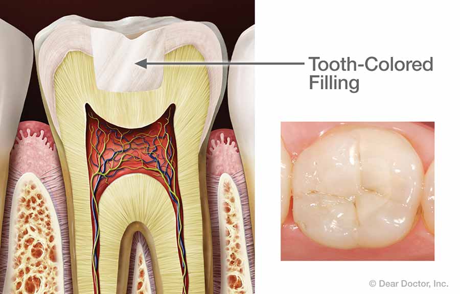 What is a Cavity Filling? - Keep 28 Dental