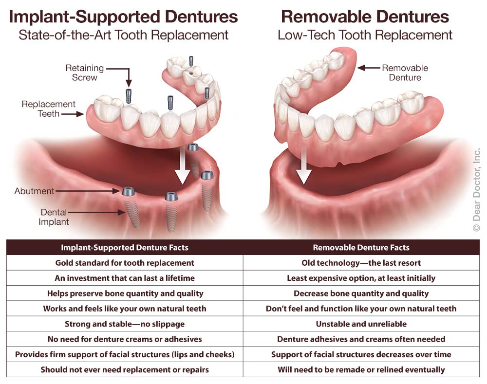 Implant supported fixed dentures vs removable dentures.