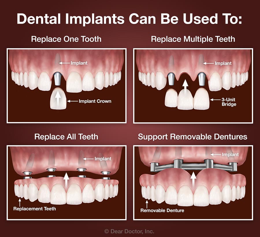 How many teeth can be implanted at once?