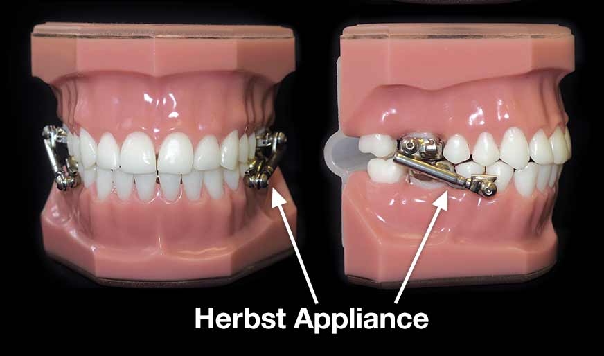 Types of Braces (Fixed Appliances)