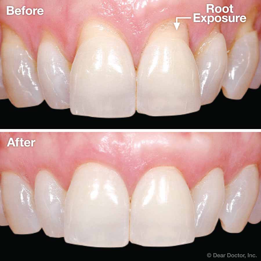 Gum Grafting before and after.