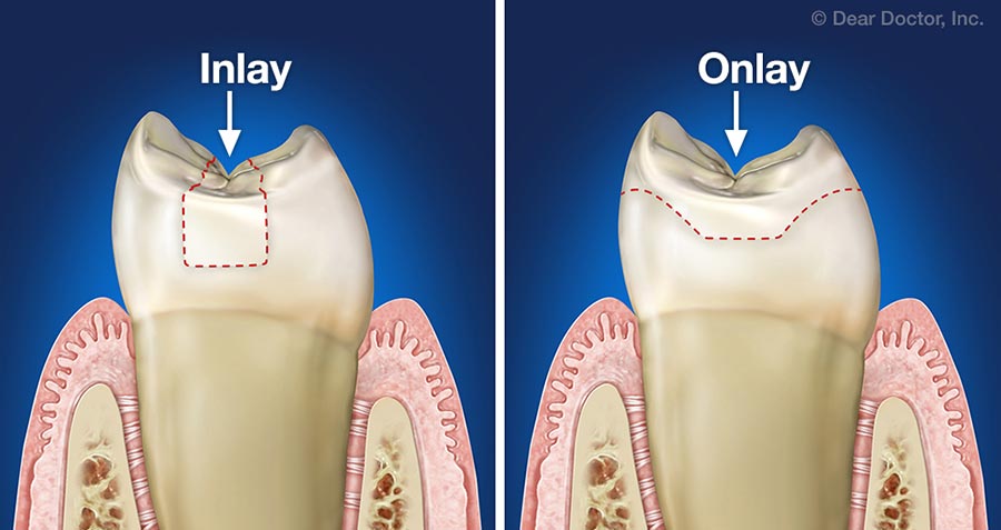 Inlay and Onlay.