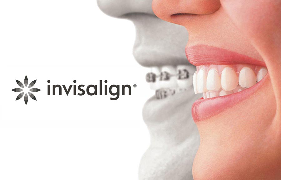 Woman wearing invisalign aligners