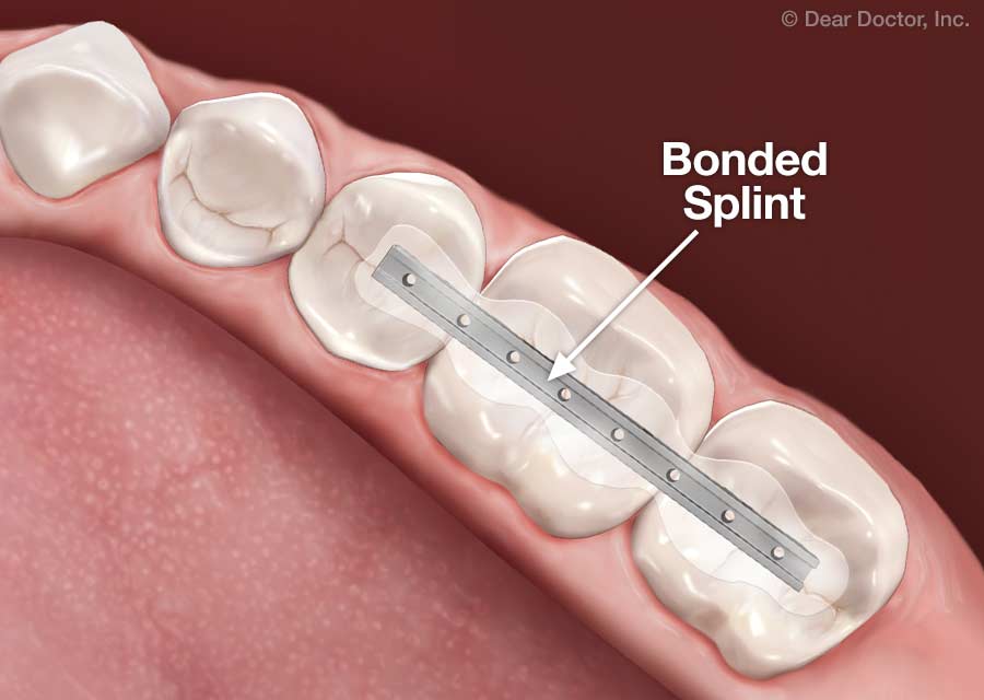 Splinting teeth.