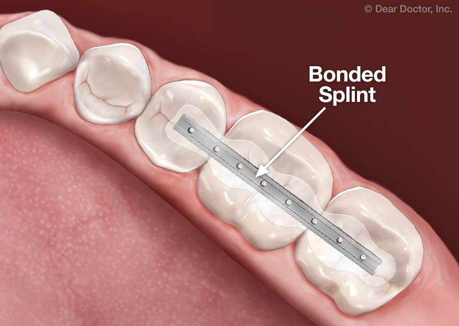 Splinting teeth.