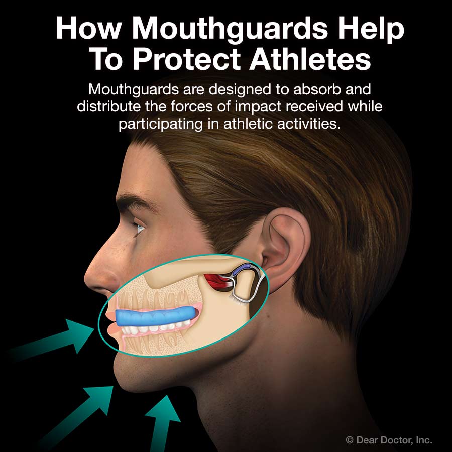 Save that shot and your child's teeth: The benefits of mouthguards