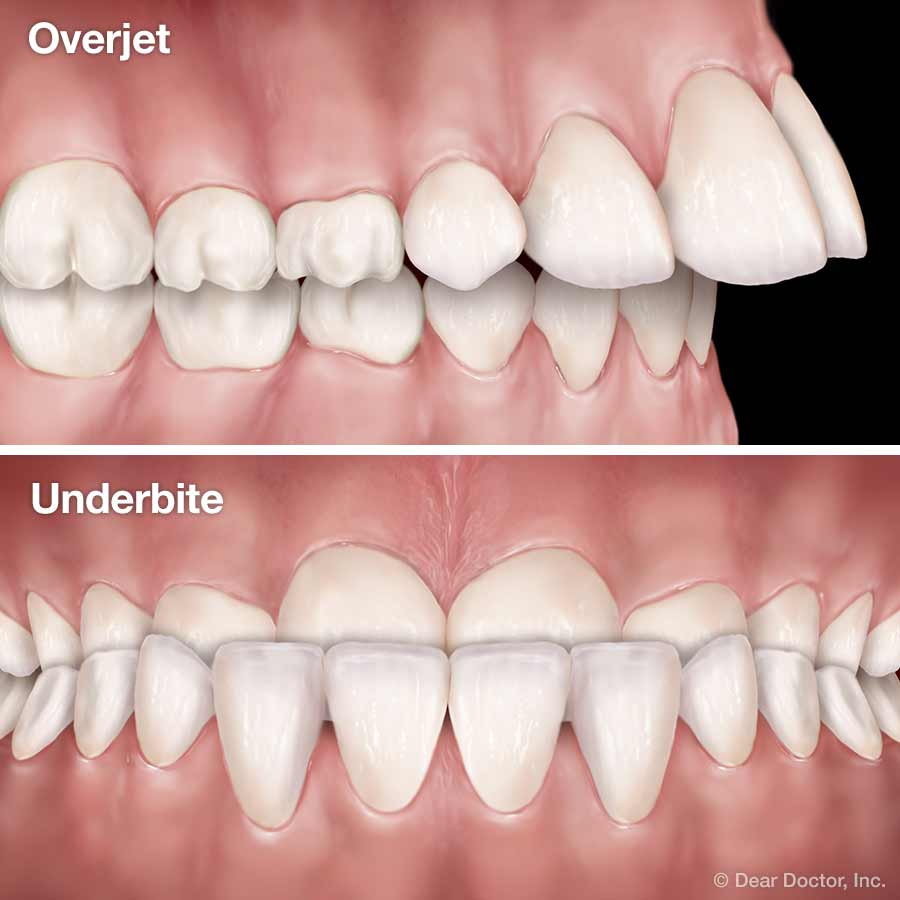 Overjet and Underbite.