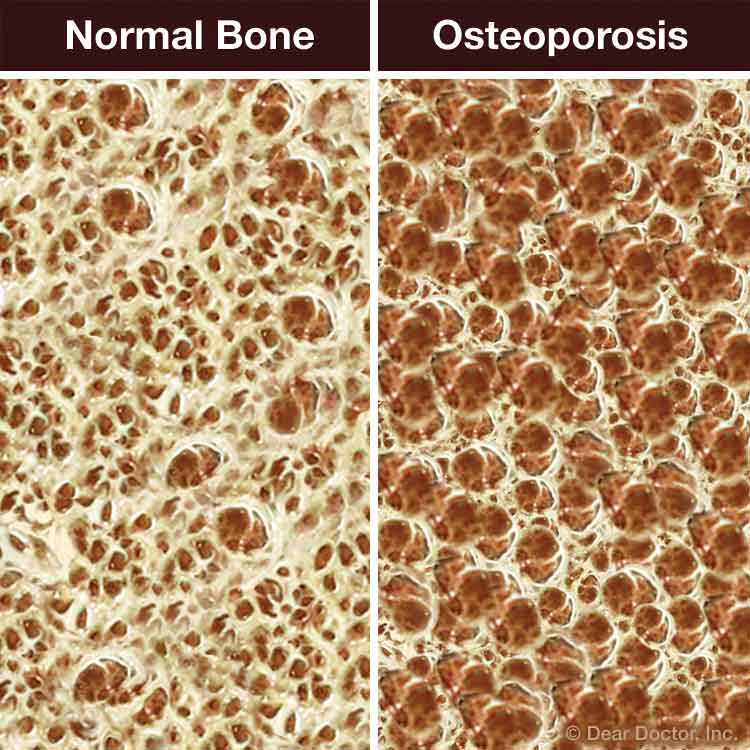 Osteoporosis And Oral Health Hilltop Dental Care