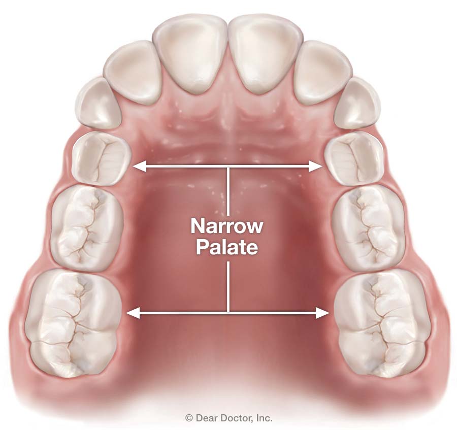 Types of Braces (Fixed Appliances)