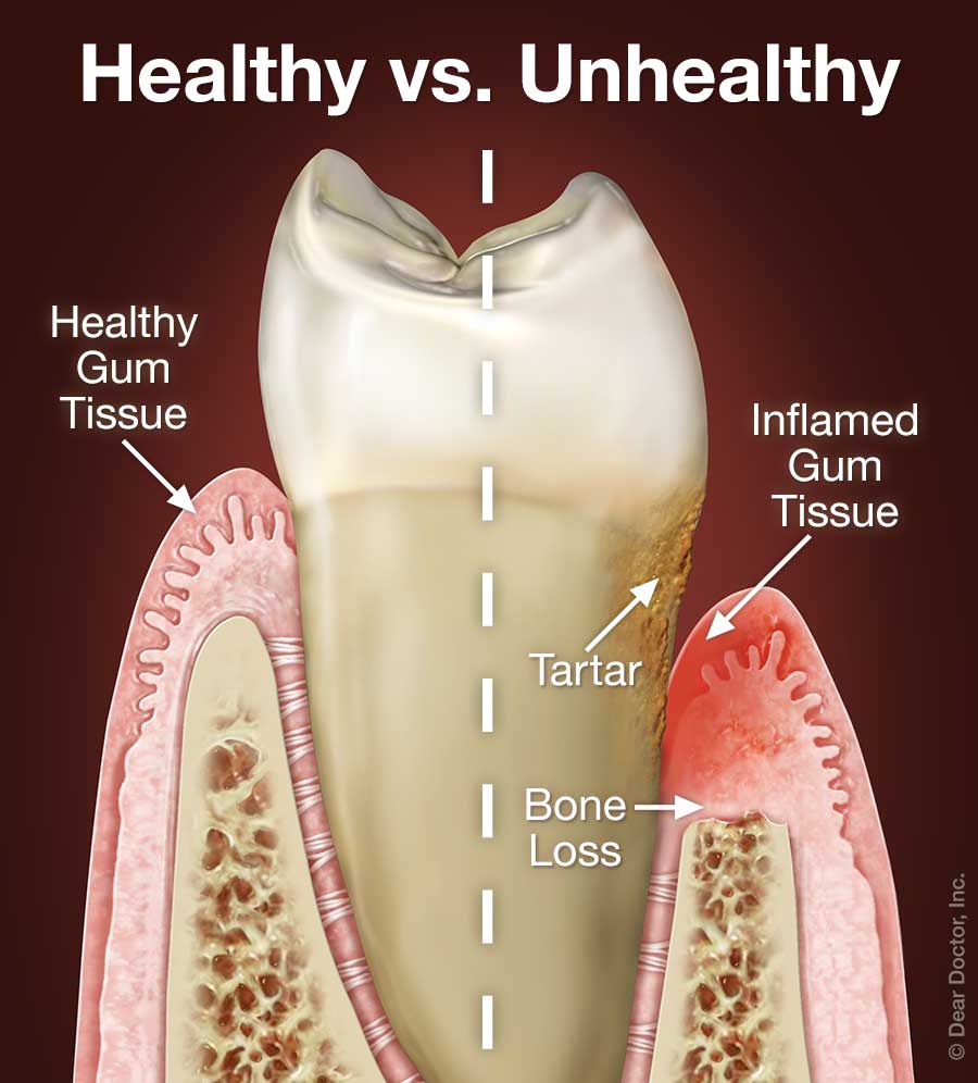 Periodontal Gum Disease Polished Dental Bismarck Nd