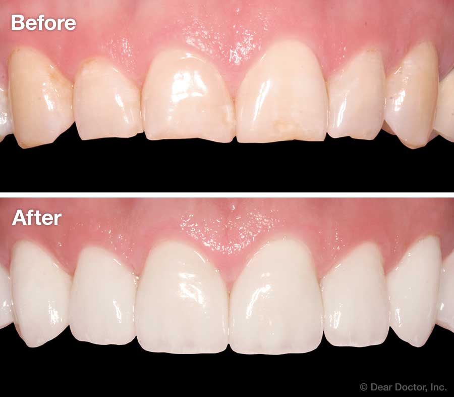 Porcelain veneers - before and after.