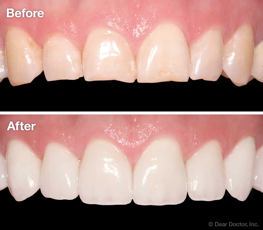 Porcelain Veneers Skokie