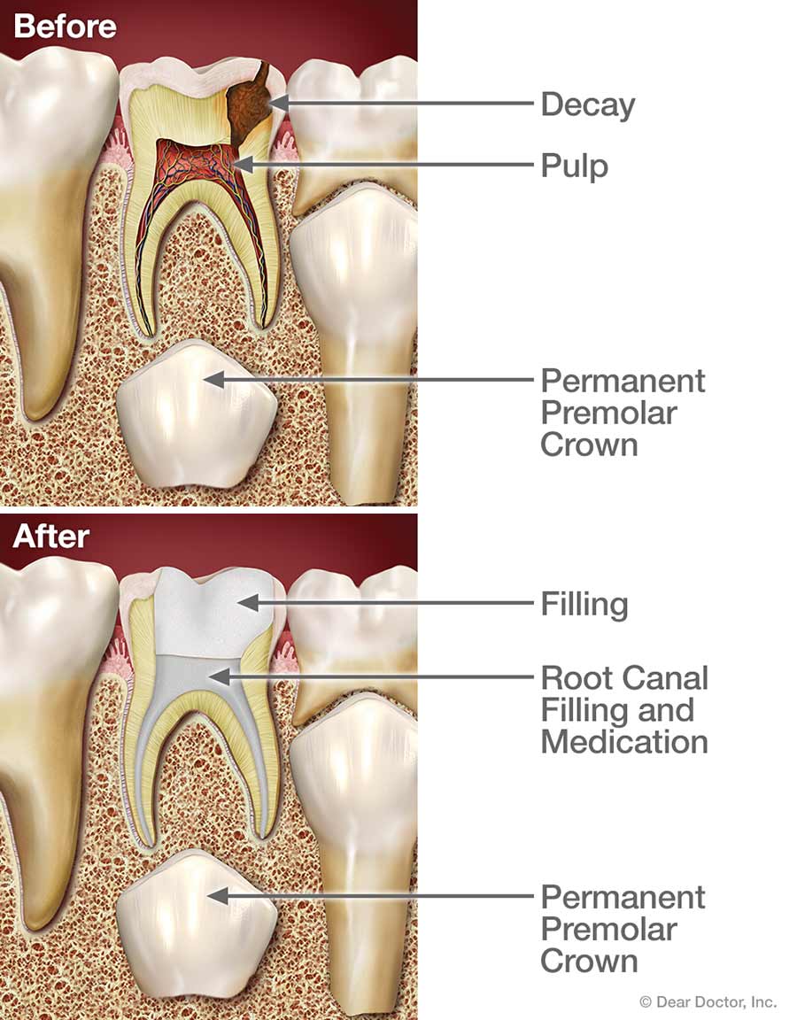 Root canal treatment for children.