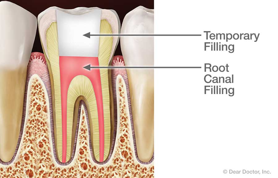 Tooth after root canal treatment.