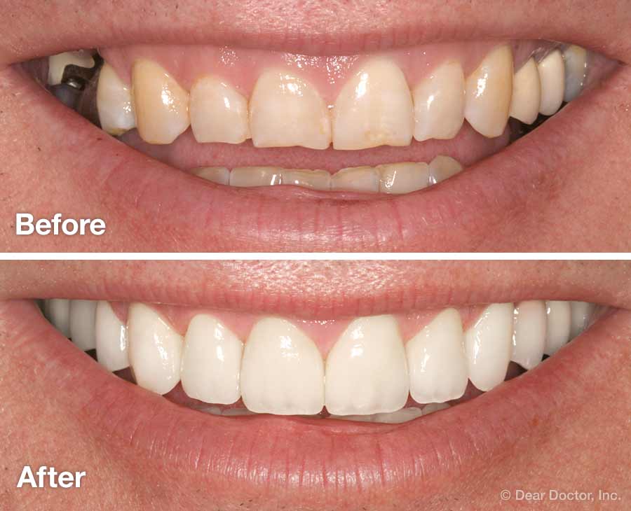 Before and After Smile Makeover.