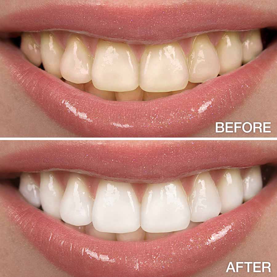 Stained or Discolored Teeth Polished Dental Bismarck ND