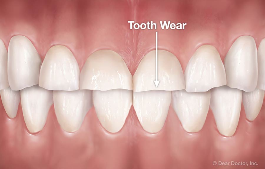 Tooth wear.