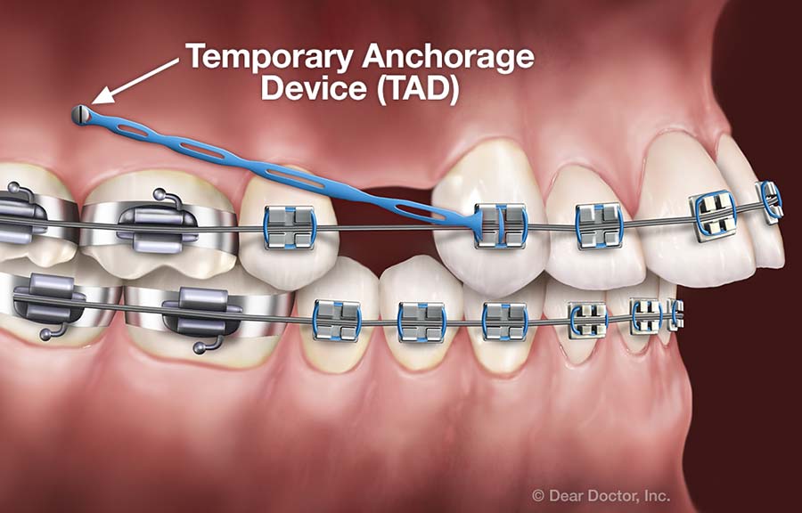 Temporary Anchorage Devices (TADS).