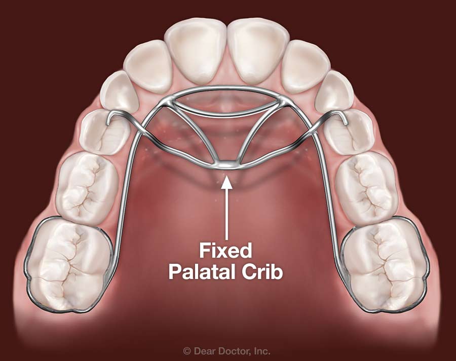 Fixed palatal crib fixing teeth